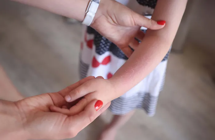 Eine erwachsene Hand untersucht die Haut eines Kindes, auf der Verbrennungen oder Hautirritationen sichtbar sind. Das Kind trägt ein Kleid mit Herz- und Streifenmuster.