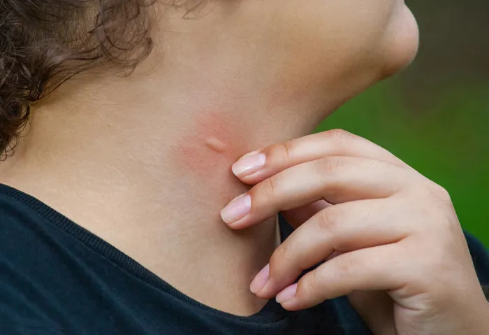 Rote, geschwollene Stelle am Hals einer Person, die von einer Hand berührt wird.