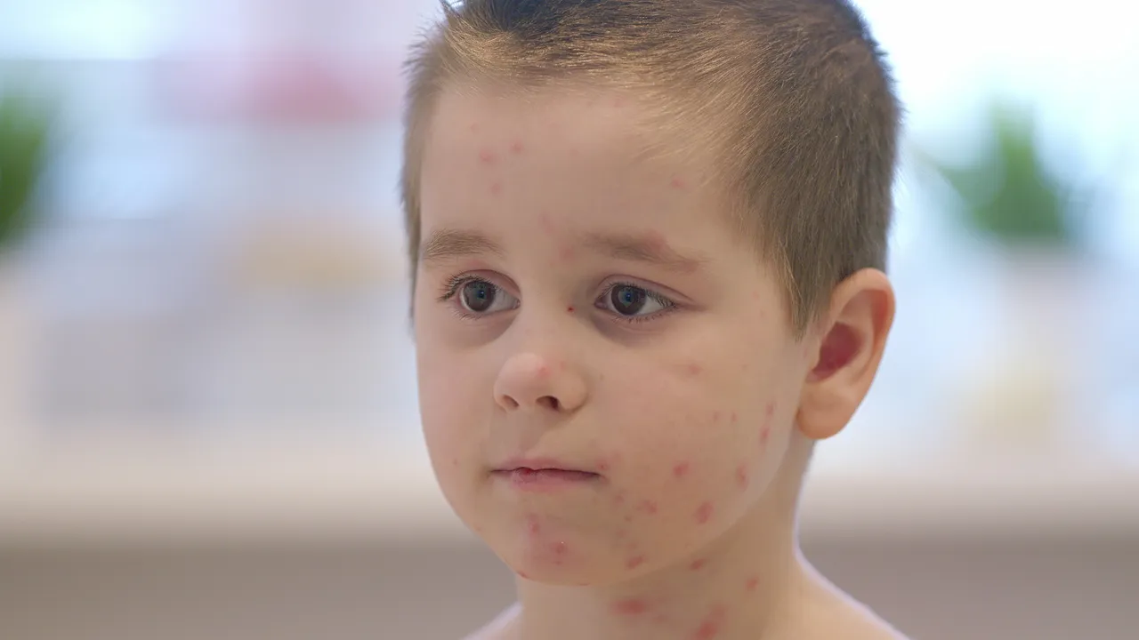 Nahaufnahme eines Jungen mit Windpocken im Gesicht und am Hals. Die Haut ist mit roten Flecken bedeckt.