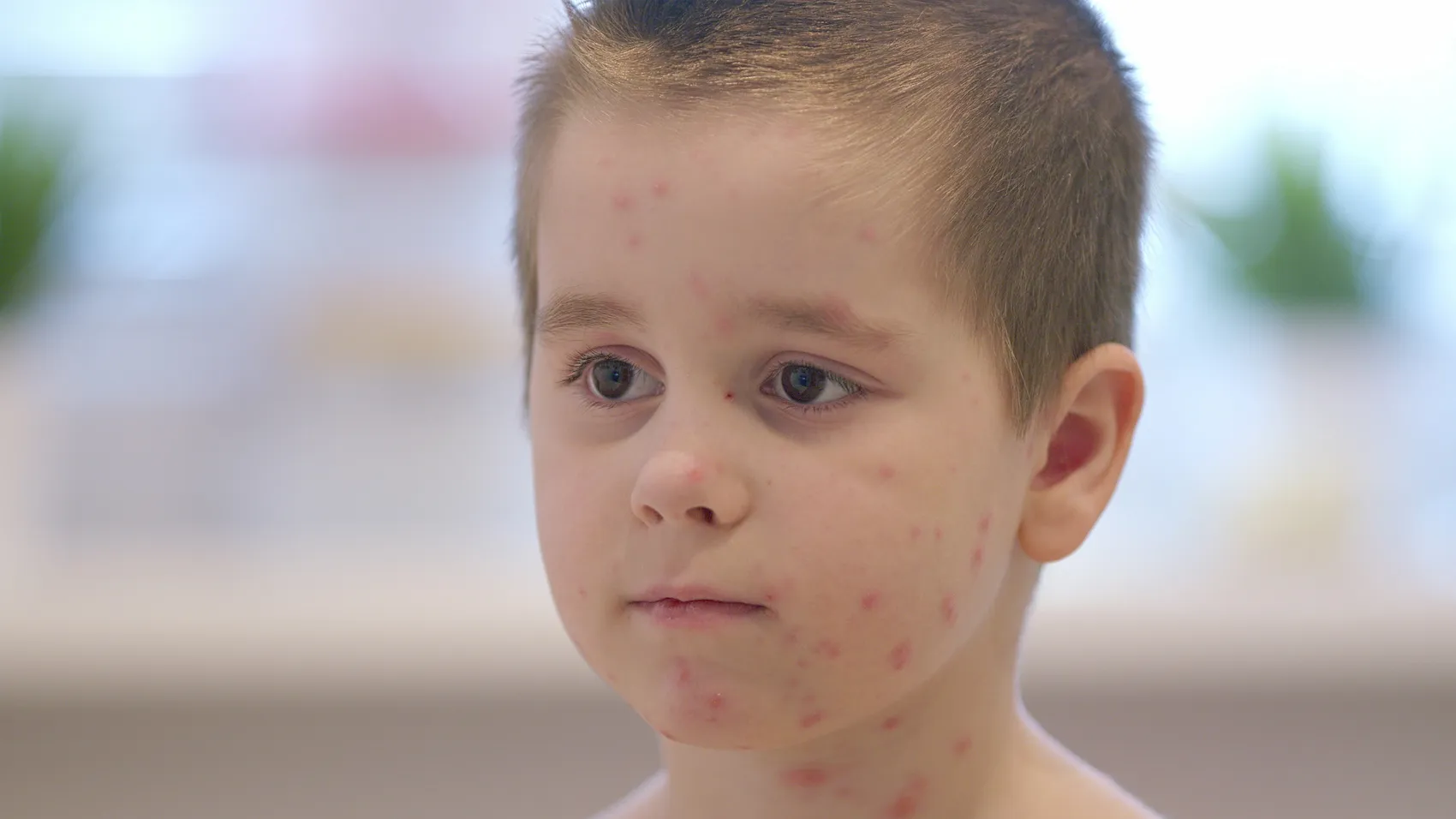 Nahaufnahme eines Jungen mit Windpocken im Gesicht und am Hals. Die Haut ist mit roten Flecken bedeckt.