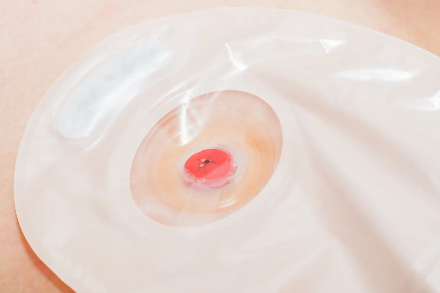 Ein transparenter Stomabeutel mit rotem Stoma auf beigefarbener Haut.